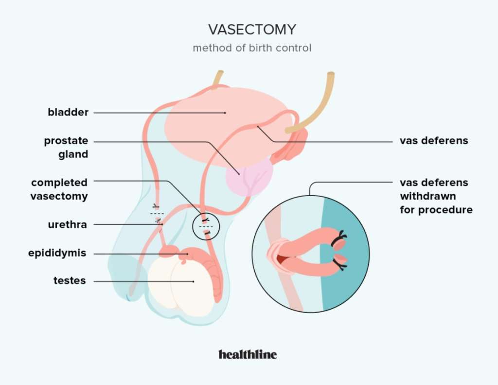 What is a Man’s Journey Through Vasectomy? - National Fitness Point